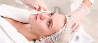 Acne Treatment