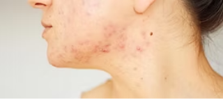 Accutane