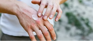 Eczema Treatment