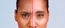 Xeomin Anti-Wrinkle Treatment