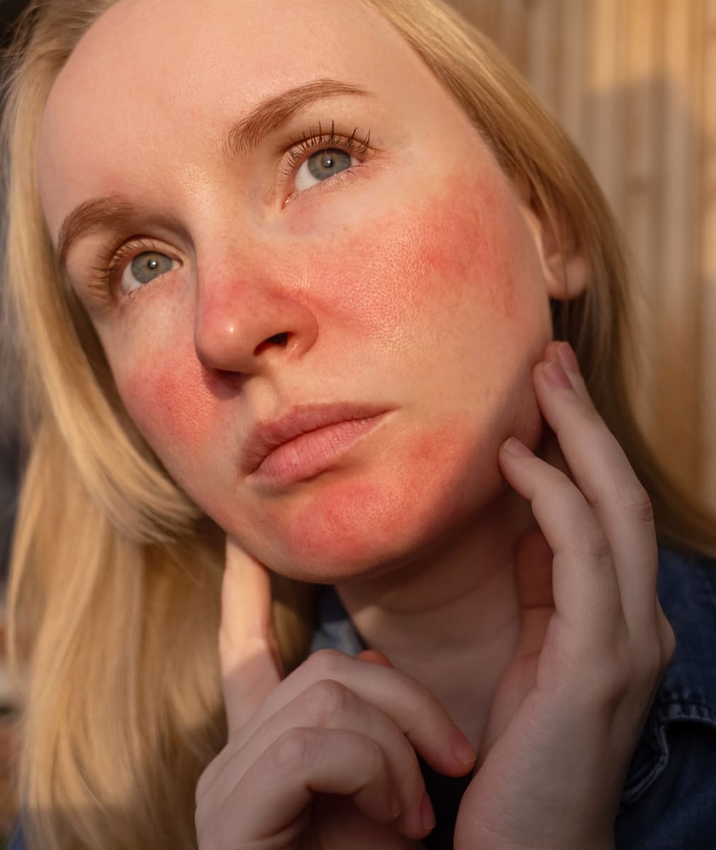Eczema (Atopic Dermatitis) Treatment