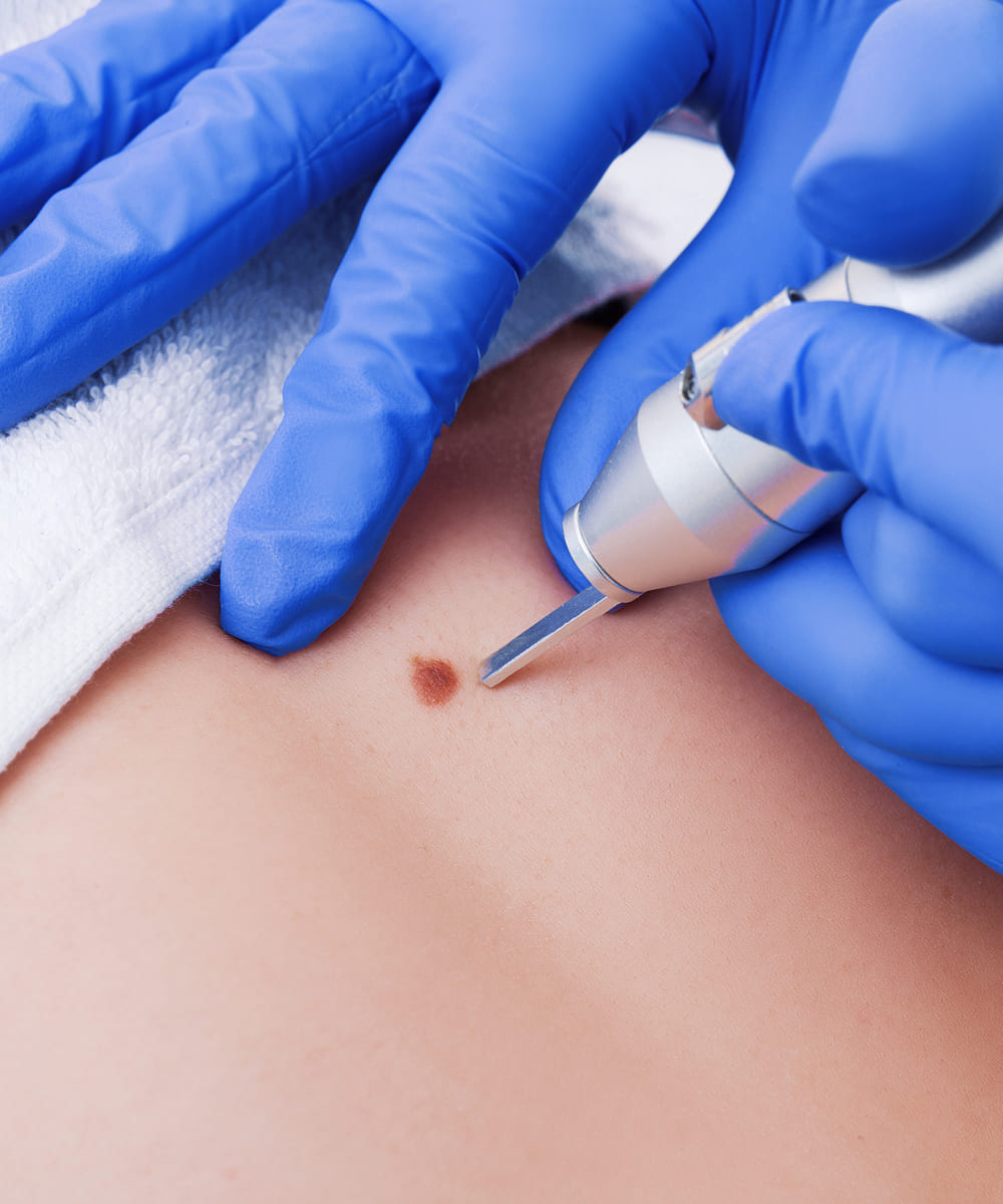 Benign & Malignant Lesion Removal