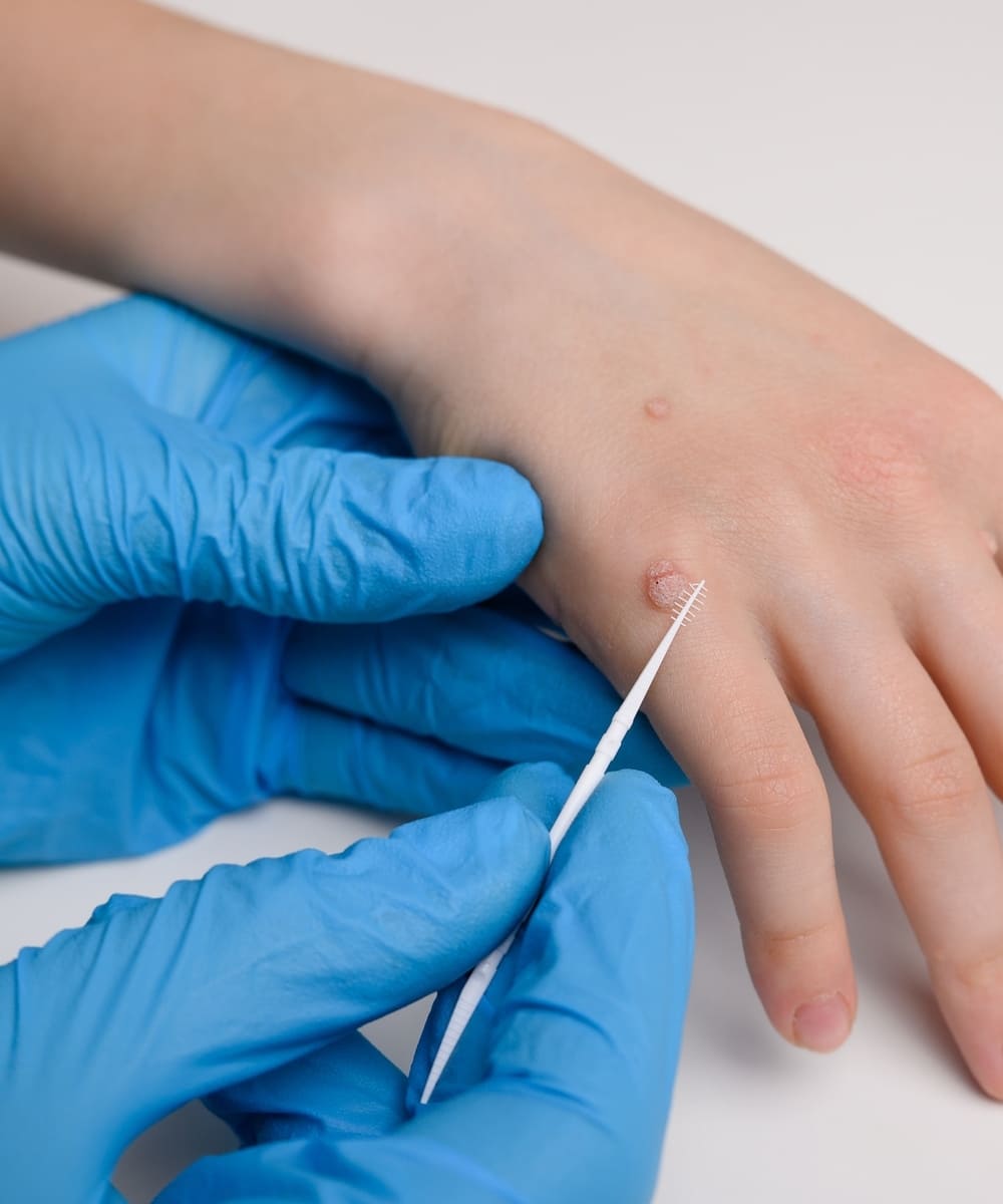 Medical Wart Removal