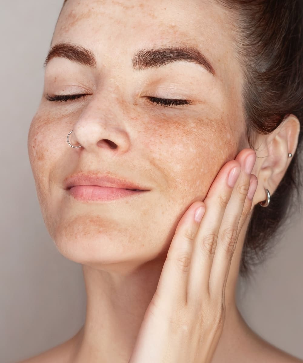 Melasma Treatment