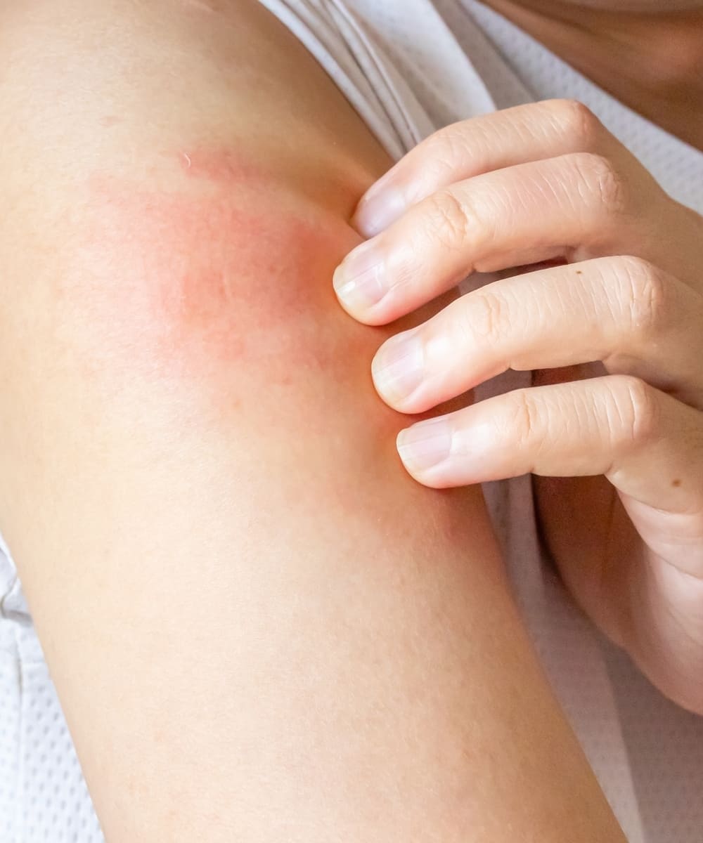 Psoriasis Treatment