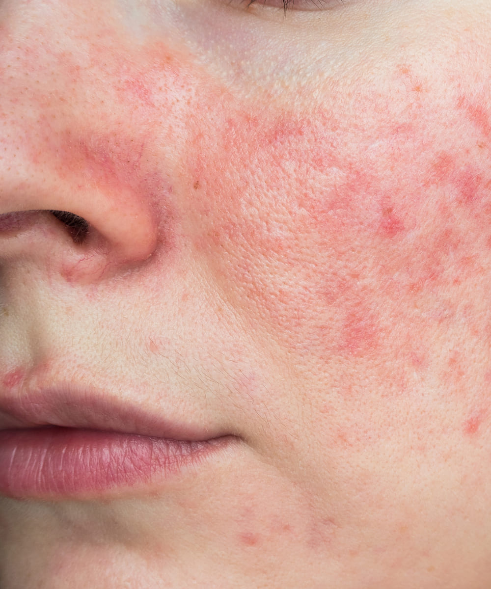Rosacea Treatment & Management