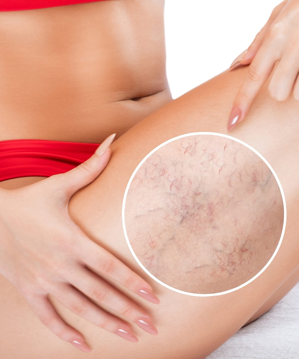 Spider Vein Treatment (Sclerotherapy)