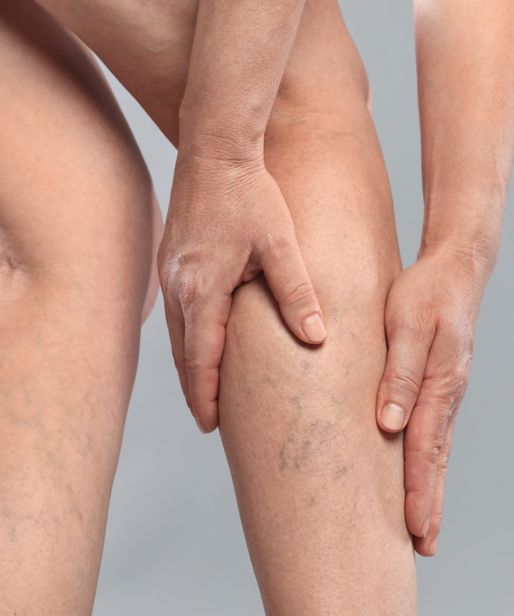 Varicose Vein Treatment & Management