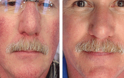 Sciton Vascular Laser Treatment