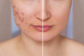 Accutane (Isotretinoin) Therapy